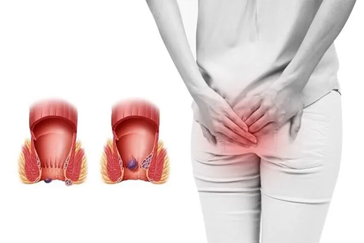 Bệnh trĩ gây bất tiện trong sinh hoạt hàng ngày.jpg
